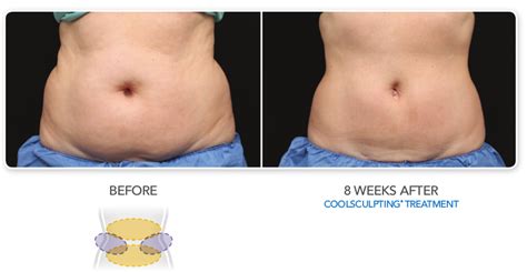 coolsculpting stomach before and after.
